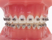 Исправление зубов